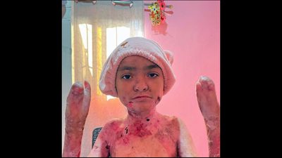 EB Skin Disease: Optimizing Pain Management During Pediatric Dressing Changes