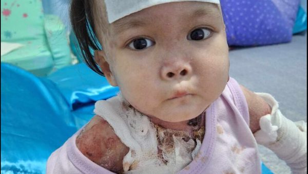 Can You Test For Epidermolysis Bullosa Before Birth? Diagnostic Methods Explored