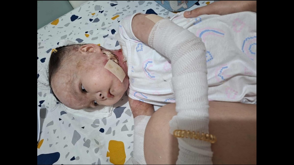 Early Symptoms Of Butterfly Skin Disease: Epidermolysis Bullosa Guide Released