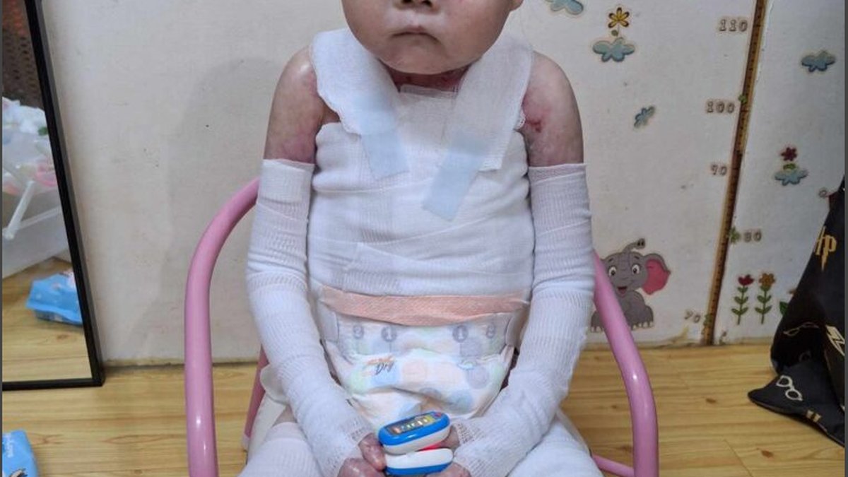 EB Babies' Life Expectancy Explained: Disease Types & Care Planning For Families