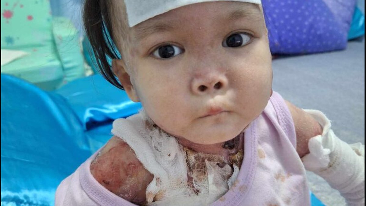 Epidermolysis Bullosa Prenatal Testing & Treatment: Donation Campaign Announced