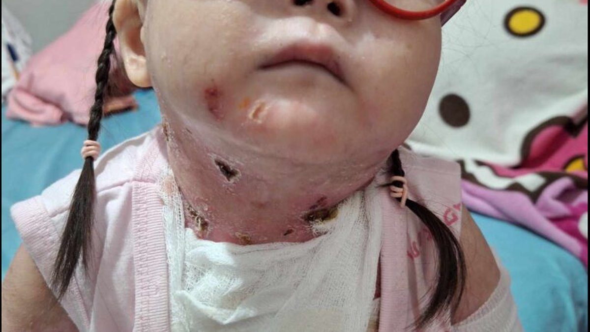 Epidermolysis Bullosa Treatment: Clinical Guidelines, Recent Advances, and Cost