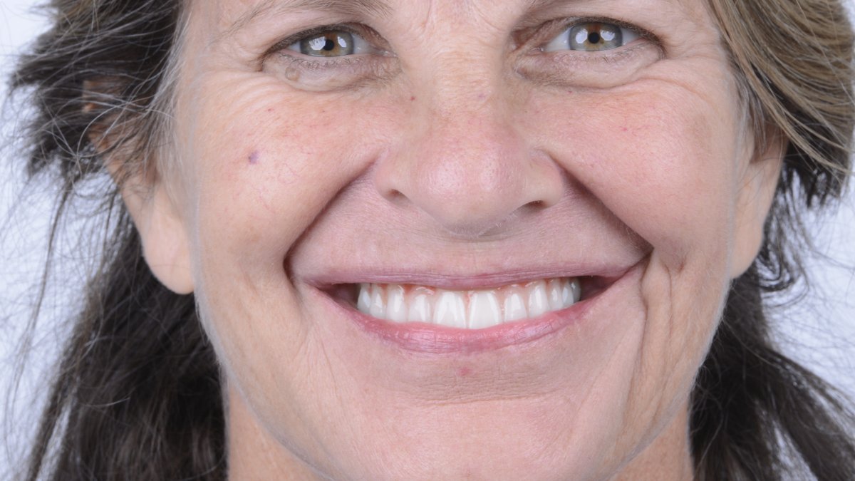 Free Dental Exam With CT Scan & X-Ray - Fusion Dental Implants Announces