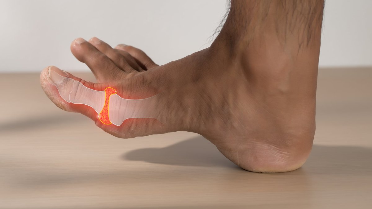 Gout Pain Relief At Home: Top Hydrotherapy Treatments & Methods Compared