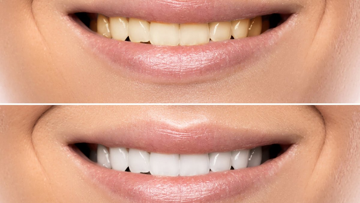 How Does Teeth Whitening Work: Costs & Process Explained by Arnold Dental