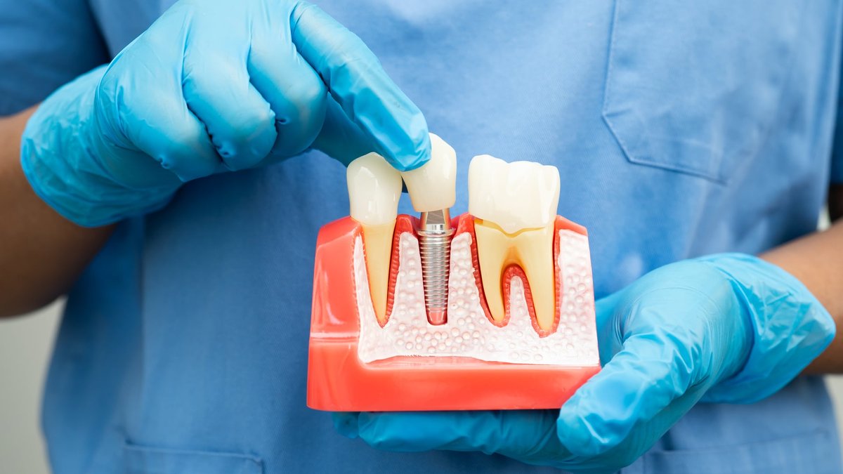 How Long Does One Dental Implant Take? Arnold Dental Explains 3D Production Time