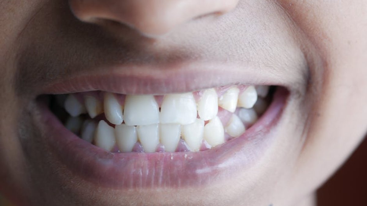 How To Fix Worn Teeth: Vancouver, WA Dentist Explains Best Treatment Options