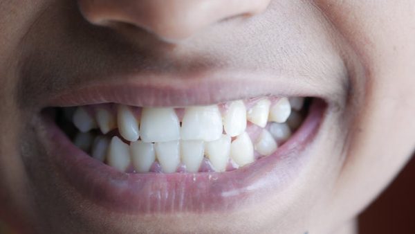 How To Fix Worn Teeth: Vancouver, WA Dentist Explains Best Treatment Options