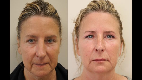 Injection Depth by Facial Zone: Balwin Aesthetics Doctor Explains Placement