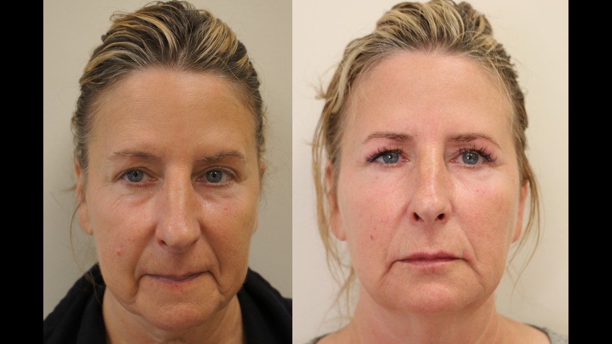Non-Surgical Facelift Using Dermal Fillers Offered by Dr Sardesai, Balwin