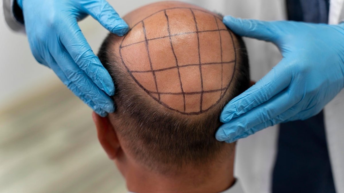 PRP & Stem Cell Therapy for Hair Loss: How Early Treatment Prevents Thinning