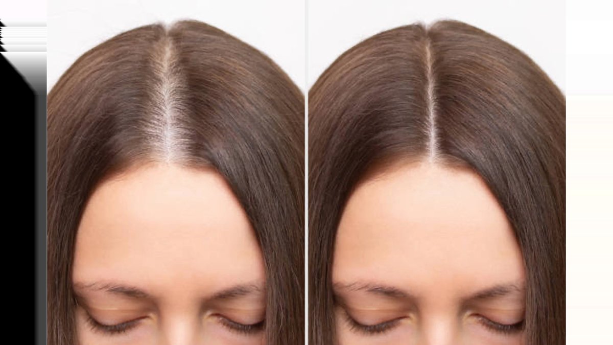 Thinning Hair vs Normal Hair Parting: Guide To Differences & Signs Published