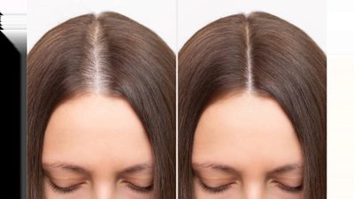 Thinning Hair vs Normal Hair Parting: How To Tell The Difference