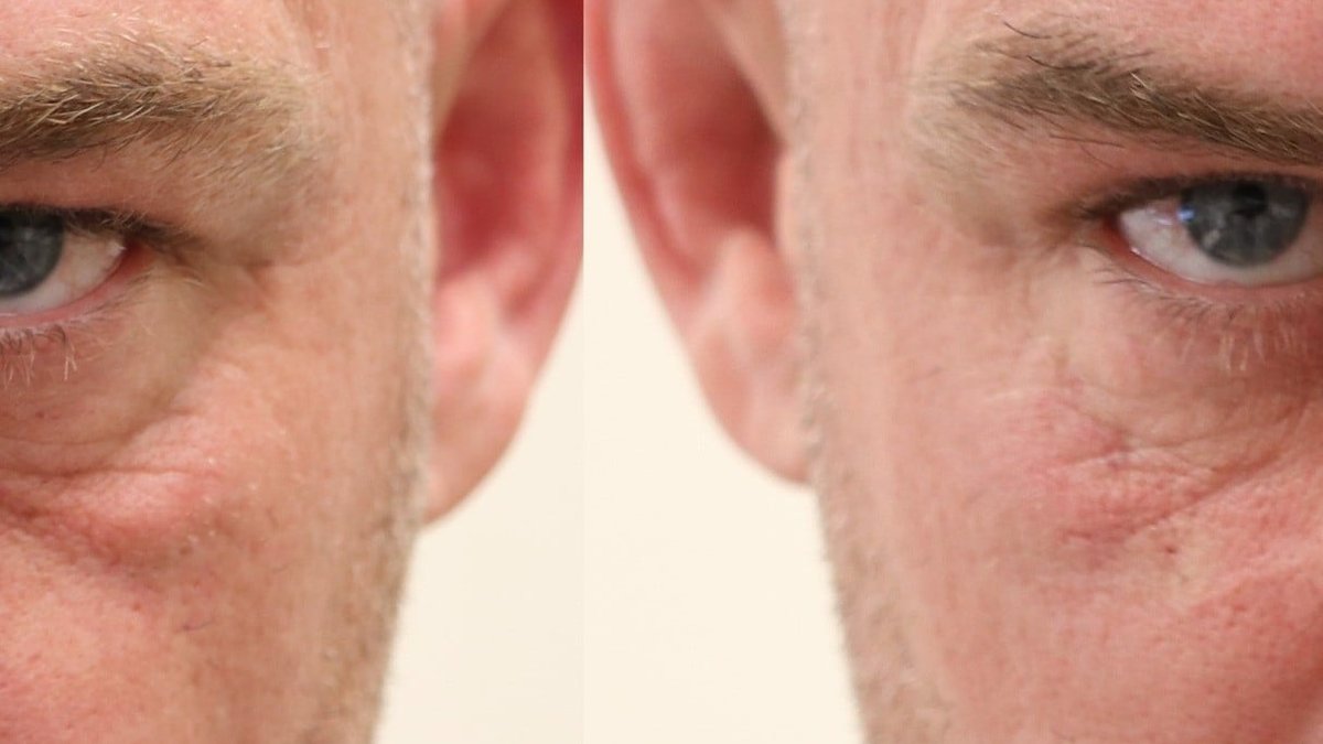 Under Eye Filler by Dr. Sardesai Now Available at Balwin Aesthetics