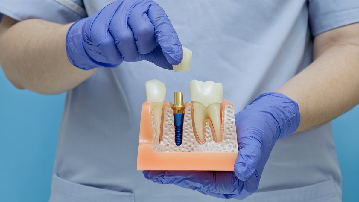 Can You Replace All Your Teeth With Implants? Nottingham Dentist Explains