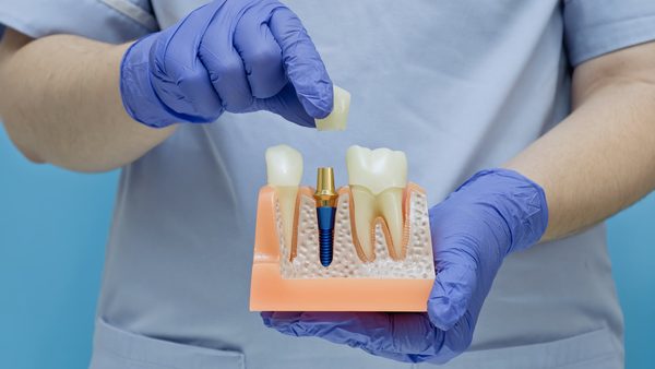 Can You Replace All Your Teeth With Implants? Nottingham Dentist Explains
