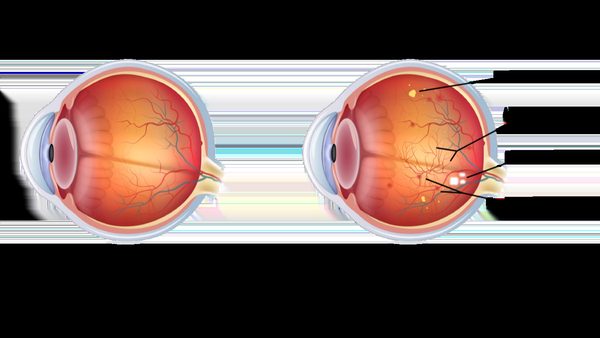 Diabetic Retinopathy: Symptoms, Treatment, and Why Regular Eye Exams Matter