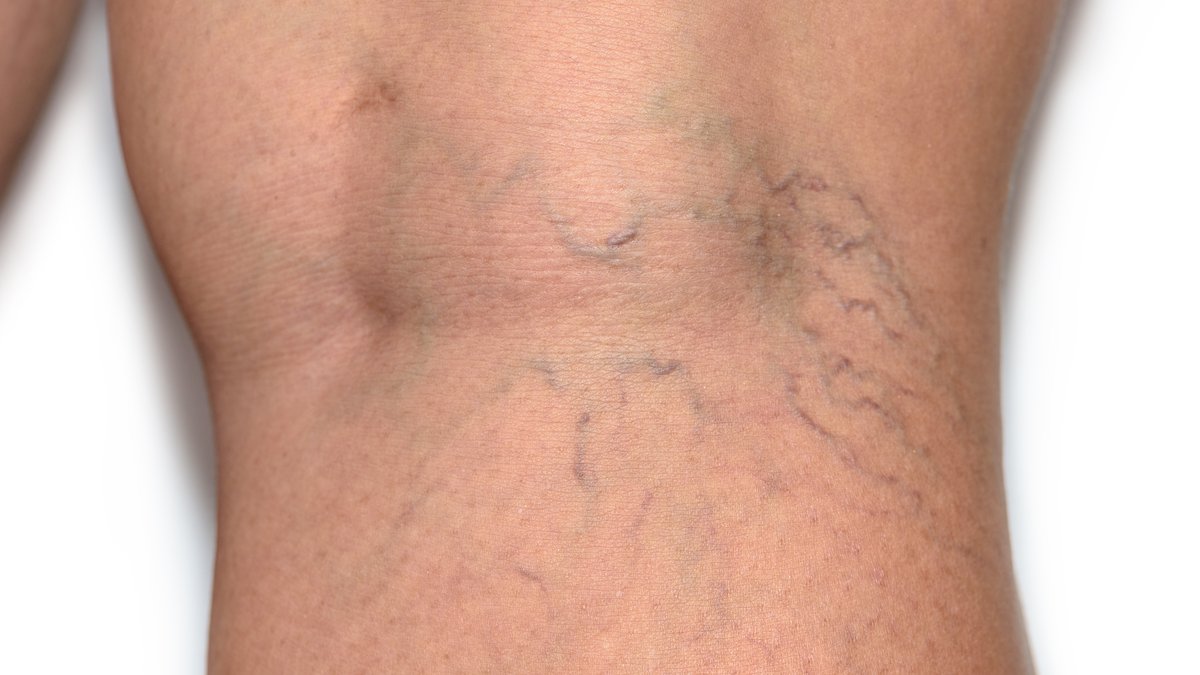 Home Remedies For Varicose Veins: How To Reduce Appearance & Itching Fast