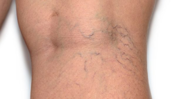 Home Remedies For Varicose Veins: How To Reduce Appearance & Itching Fast