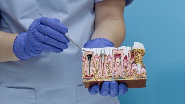 Root Canal Treatment in Nottingham: Prices, Procedure & Results