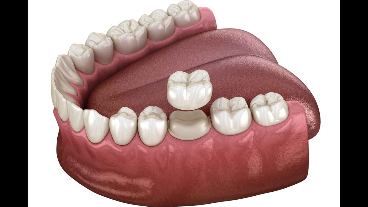 Why Are Dental Crowns So Expensive? Cleburne, TX Dentists Break Down The Costs