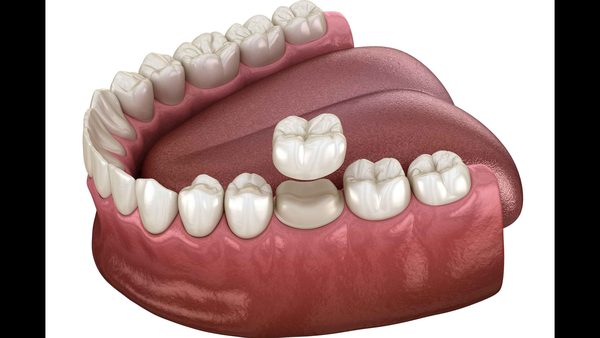 Why Are Dental Crowns So Expensive? Cleburne, TX Dentists Break Down The Costs