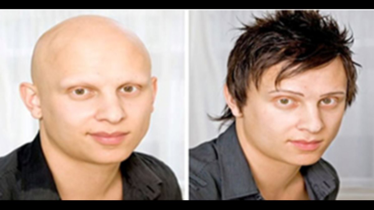 Custom Hair Replacement Systems Compared - New Review Published