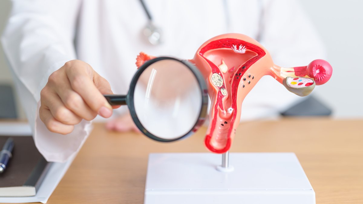Naturopathic Treatment for Endometriosis: Diet, Lifestyle & Therapy Options