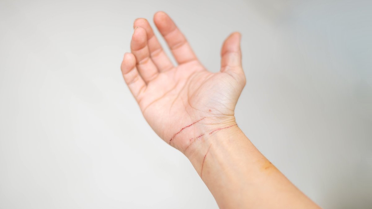 Signs That A Teen Is Self-Harming: Intervention Guide For Parents Released