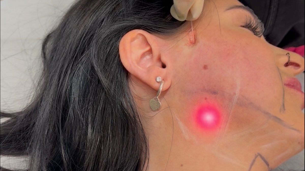 Atlanta Endolift Treatment: Guide to Benefits, Recovery, Ideal Patient Released