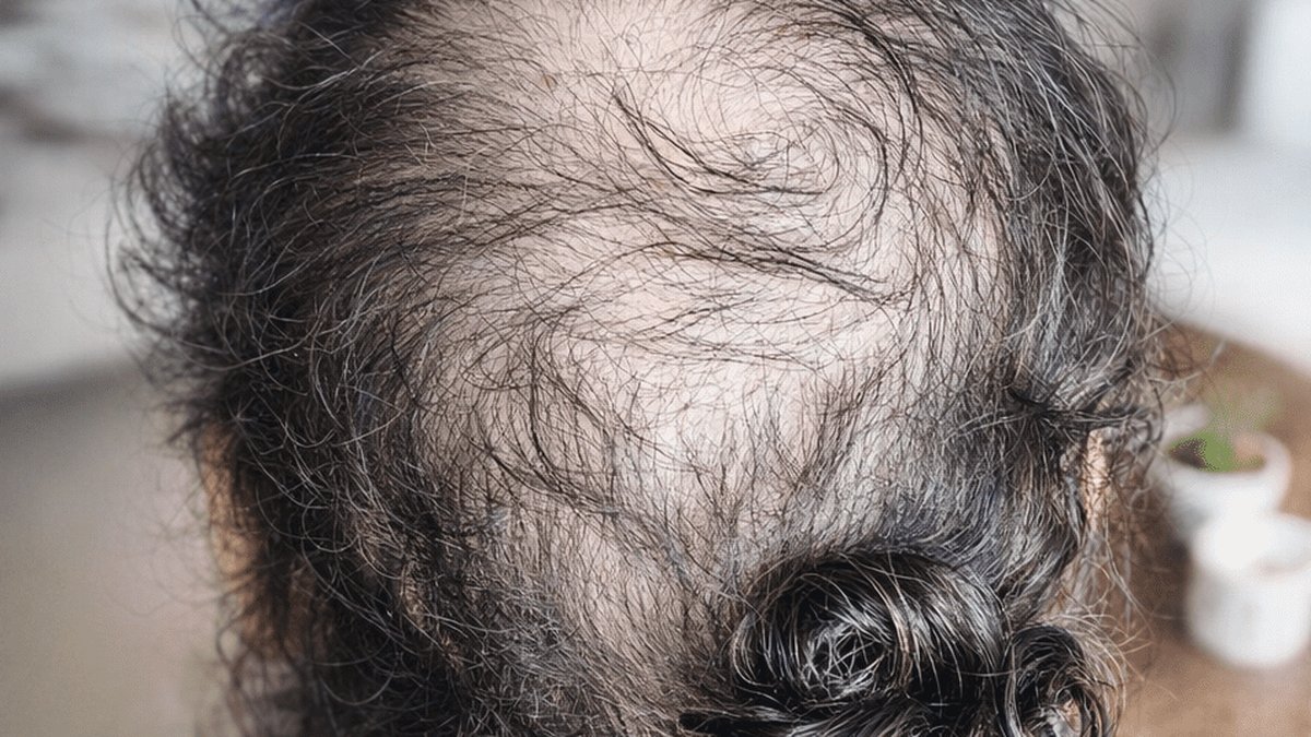 Dreadlocks by KNOT Publishes New Guide to Traction Alopecia Risks