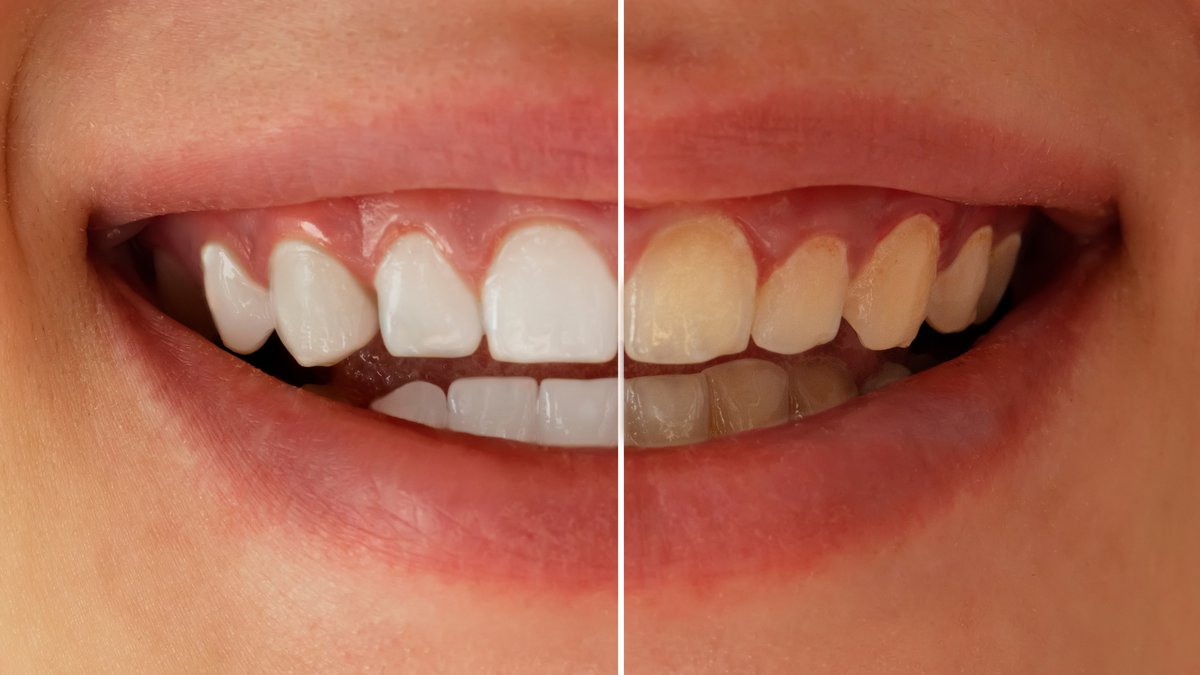 How to Whiten Aging Yellow Teeth: Tips & Procedure Explained by Nottingham Pro